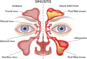 Sinusitis |